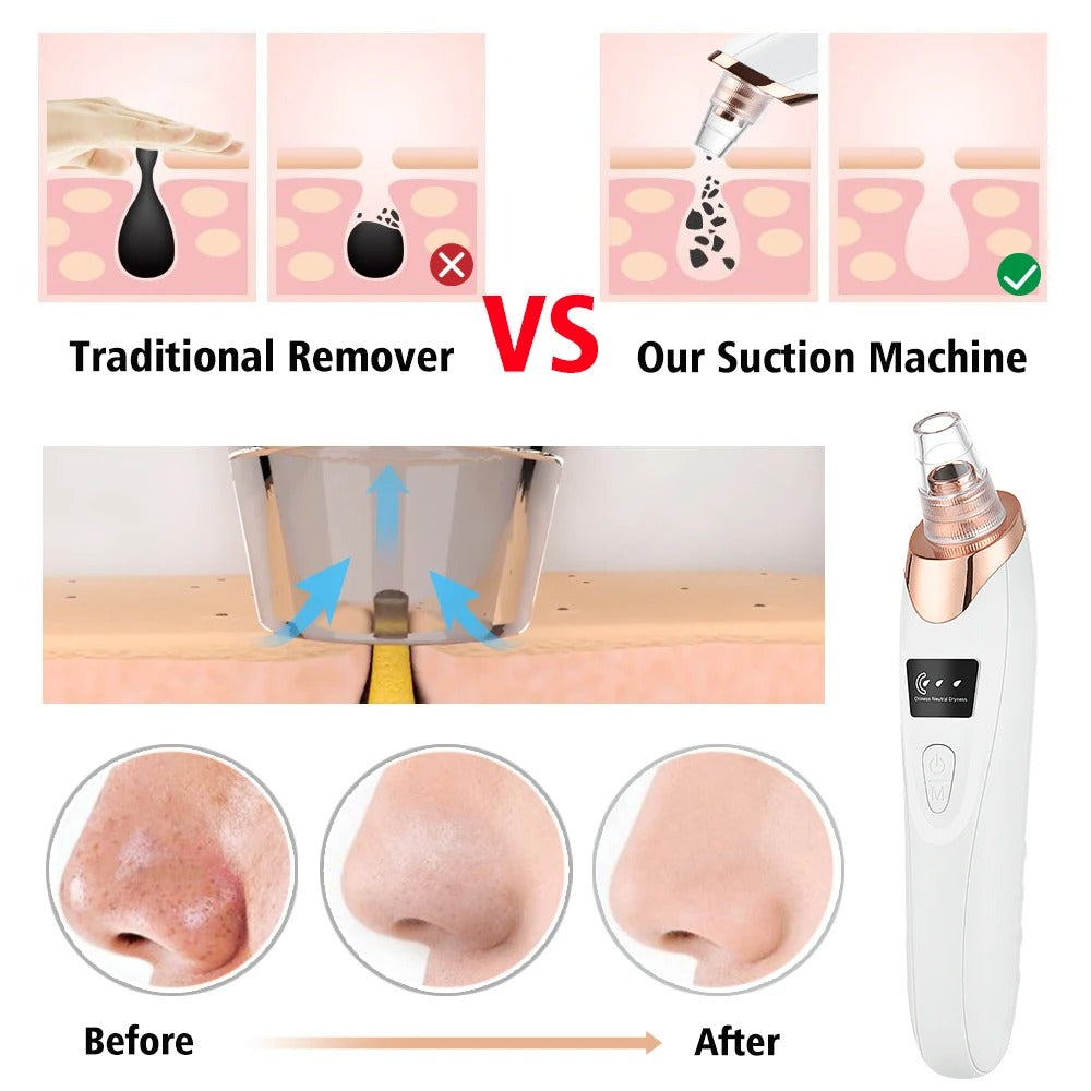 Face Vacuum Suction Blackhead Remover – Deep Pore Cleansing Device